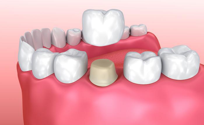 Same-day CEREC dental crowns