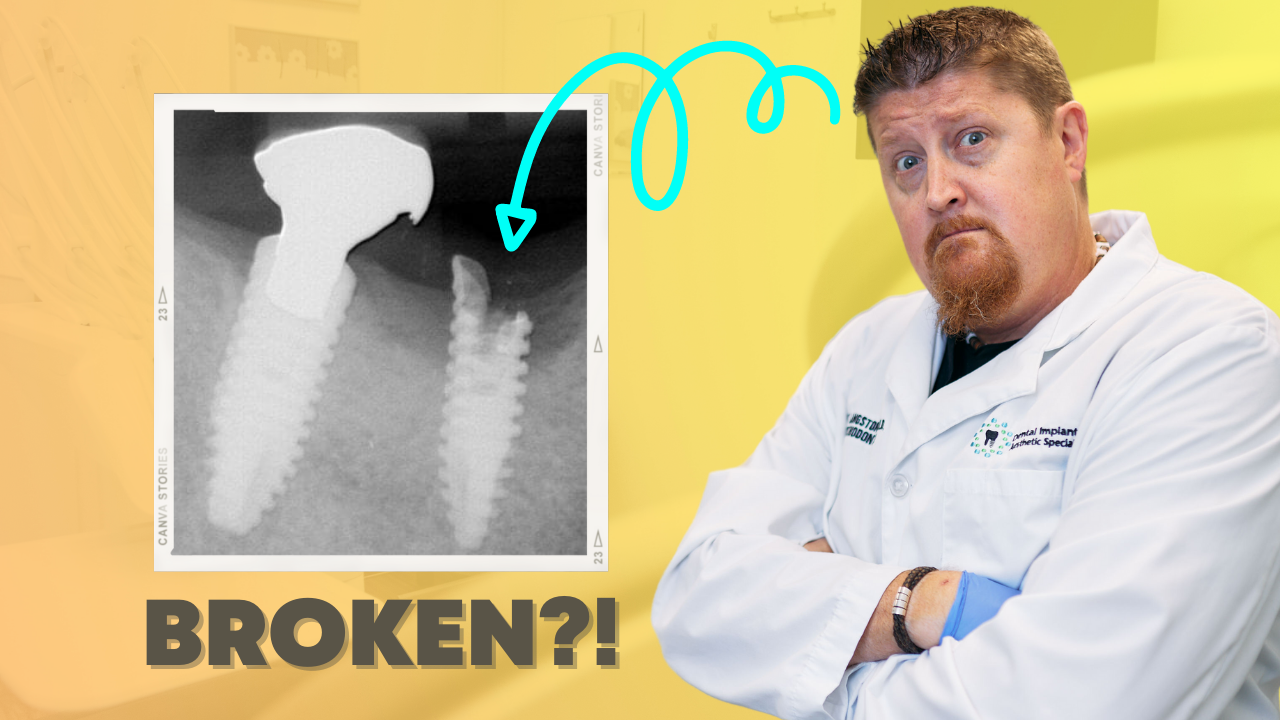 Can Dental Implants Break
