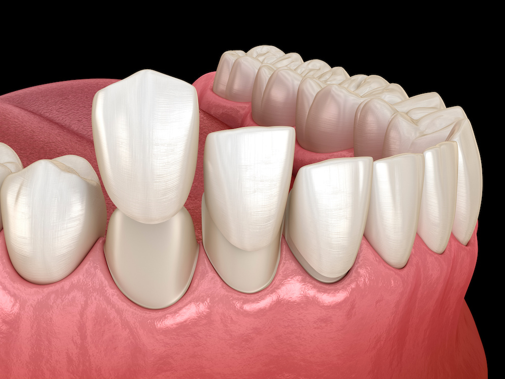 Dental veneer placement procedure. Dental 3D illustration