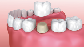Dental Crowns and Same-Day Dental Crowns Diagram