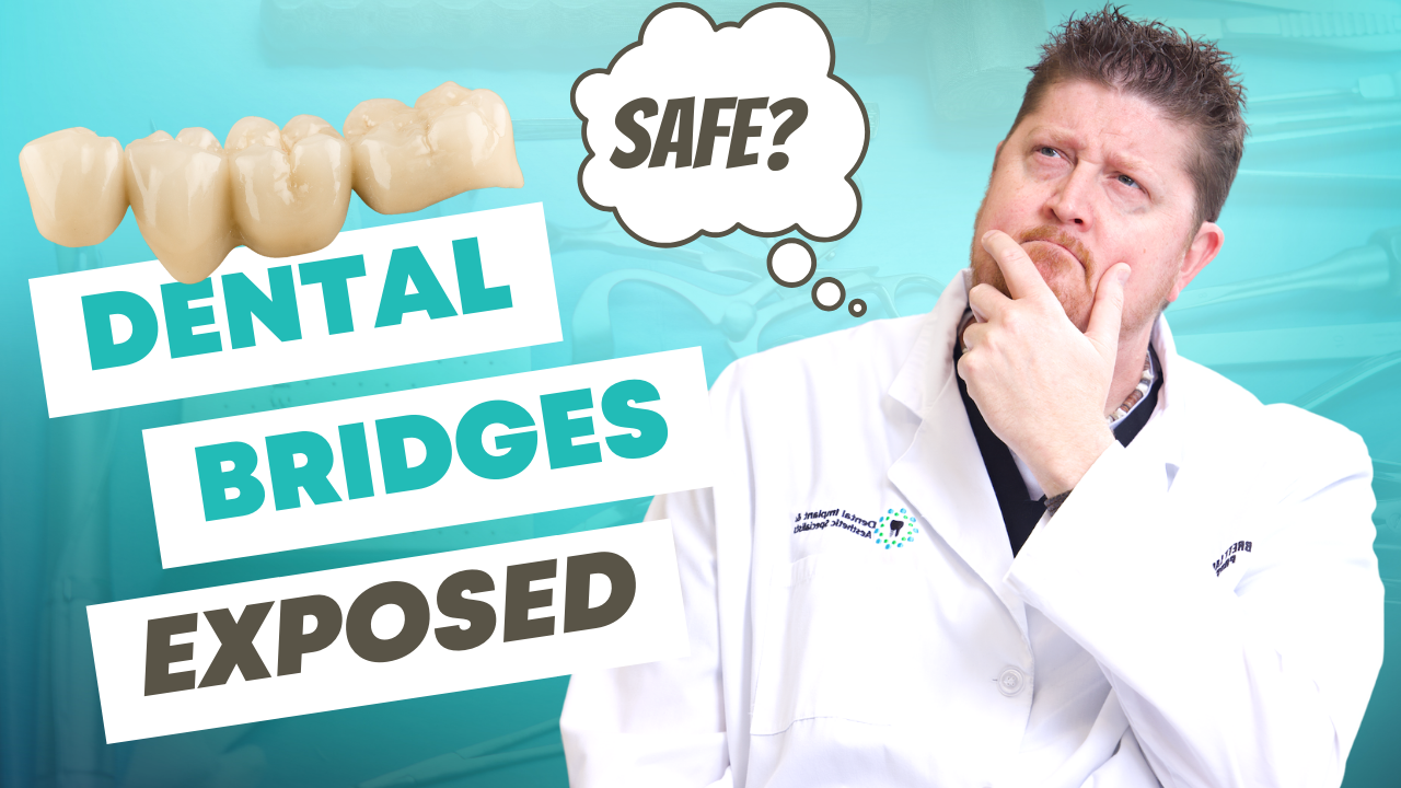Dental Bridges Exposed