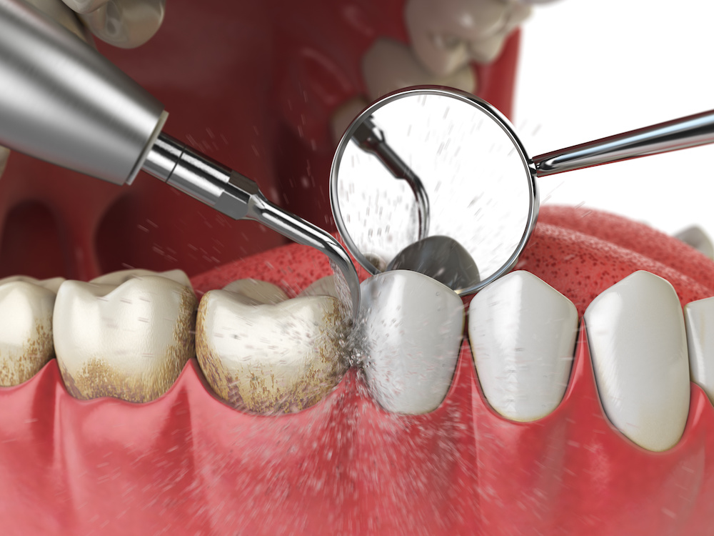 When Do You Need Deep Teeth Cleaning? | Dental Implant & Aesthetic  Specialists